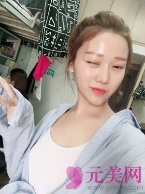 北京垫下巴+硅胶假体隆鼻手术前后对比恢复过程日记