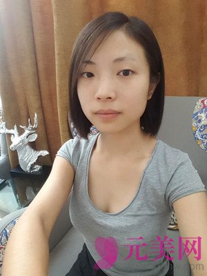 小眼睛做完眼部手术双眼皮+开眼角前后恢复过程
