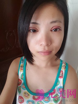 小眼睛做完眼部手术双眼皮+开眼角前后恢复过程