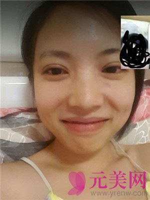 小眼睛做完眼部手术双眼皮+开眼角前后恢复过程