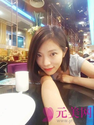 小眼睛做完眼部手术双眼皮+开眼角前后恢复过程