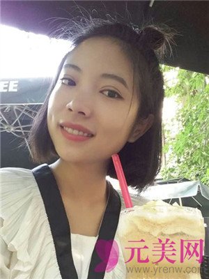 小眼睛做完眼部手术双眼皮+开眼角前后恢复过程