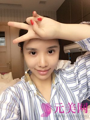 自体脂肪填充太阳穴和脸颊前后对比图过程日记