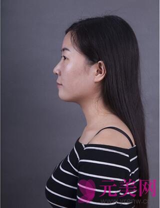 双眼皮手术一个月后隆鼻手术前后对比照真人日记