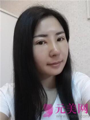 双眼皮手术一个月后隆鼻手术前后对比照真人日记