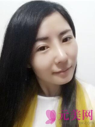 双眼皮手术一个月后隆鼻手术前后对比照真人日记