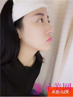 合肥韩美闫品行隆鼻怎么样?真人案例及价格
