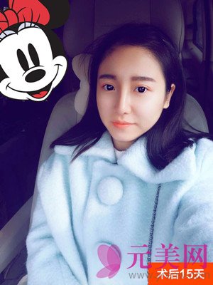 合肥韩美闫品行隆鼻怎么样?真人案例及价格