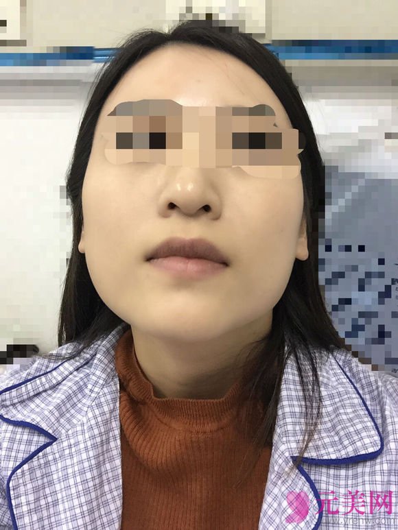 成都娇点姜宇禄磨下颌角怎么样?价格?真人案