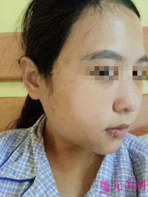 成都娇点姜宇禄磨下颌角怎么样?价格?真人案