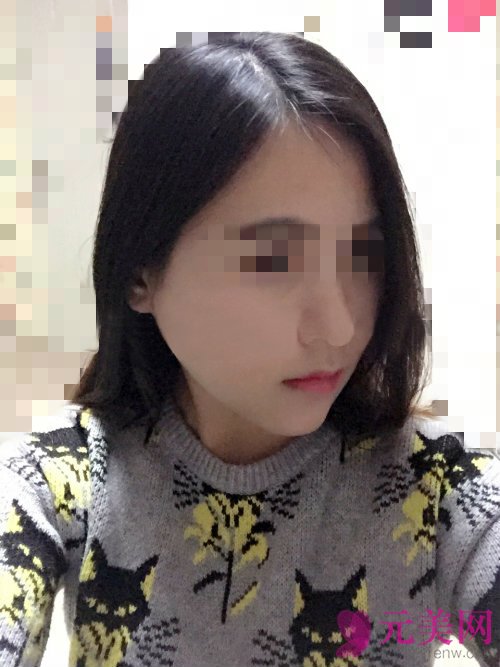 成都娇点姜宇禄磨下颌角怎么样?价格?真人案