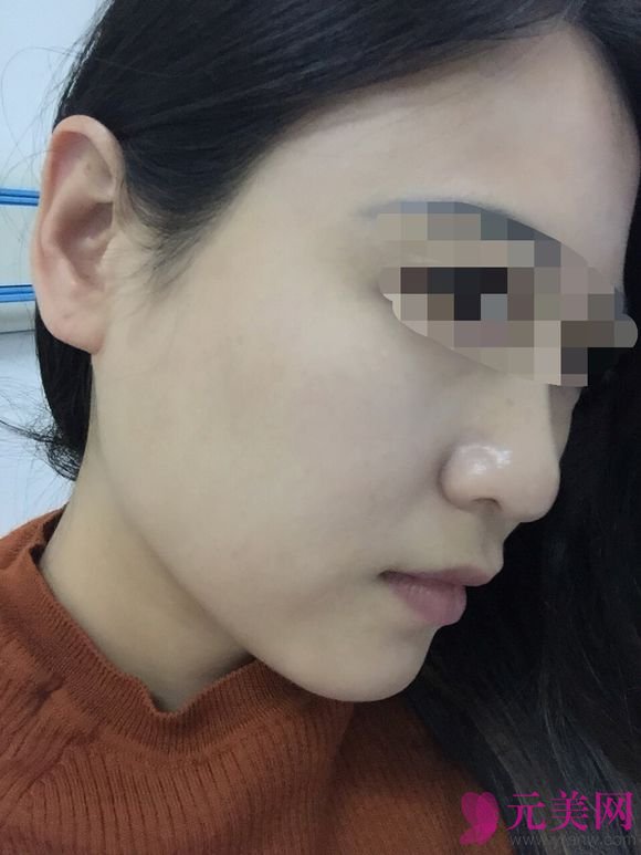 成都娇点姜宇禄磨下颌角怎么样?价格?真人案