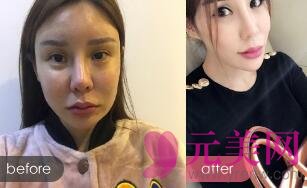 广州壹加壹林晓双做超声提拉前后对比真人案例