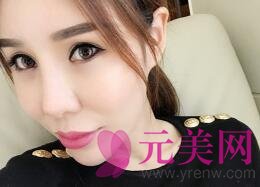 广州壹加壹林晓双做超声提拉前后对比真人案例