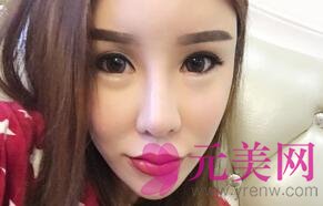广州壹加壹林晓双做超声提拉前后对比真人案例