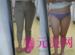 武汉爱思徐庶吸脂怎么样?价格?前后真人案例