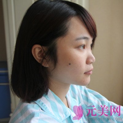 上海伊莱美王世专隆鼻怎么样?价格?前后真人案例