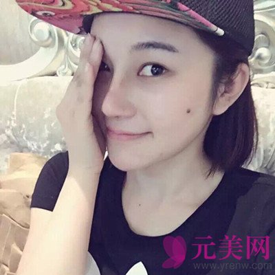 上海伊莱美王世专隆鼻怎么样?价格?前后真人案例
