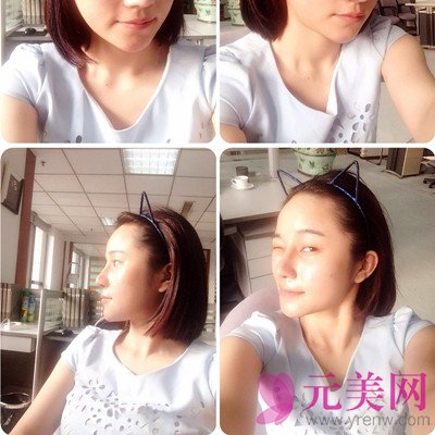 上海伊莱美王世专隆鼻怎么样?价格?前后真人案例