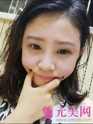 保定蓝山杜建龙隆鼻怎么样?眼部手术鼻部手术对比案例