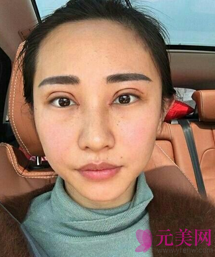 全切双眼皮+开眼角手术,53天恢复照片
