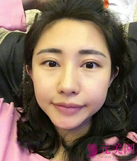全切双眼皮+开眼角手术,53天恢复照片