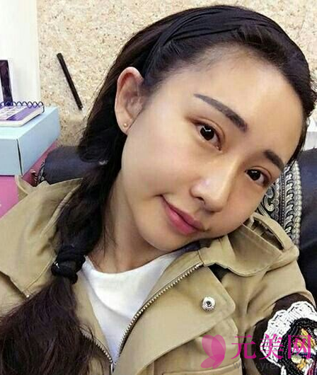 全切双眼皮+开眼角手术,53天恢复照片
