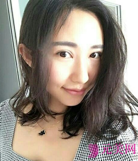 全切双眼皮+开眼角手术,53天恢复照片