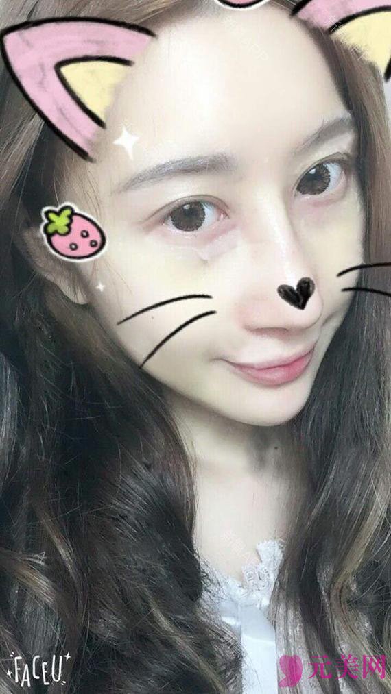 假体隆鼻+耳软骨垫鼻尖
