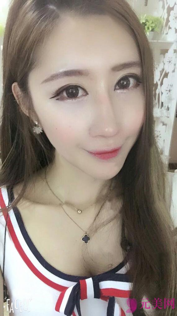 假体隆鼻+耳软骨垫鼻尖