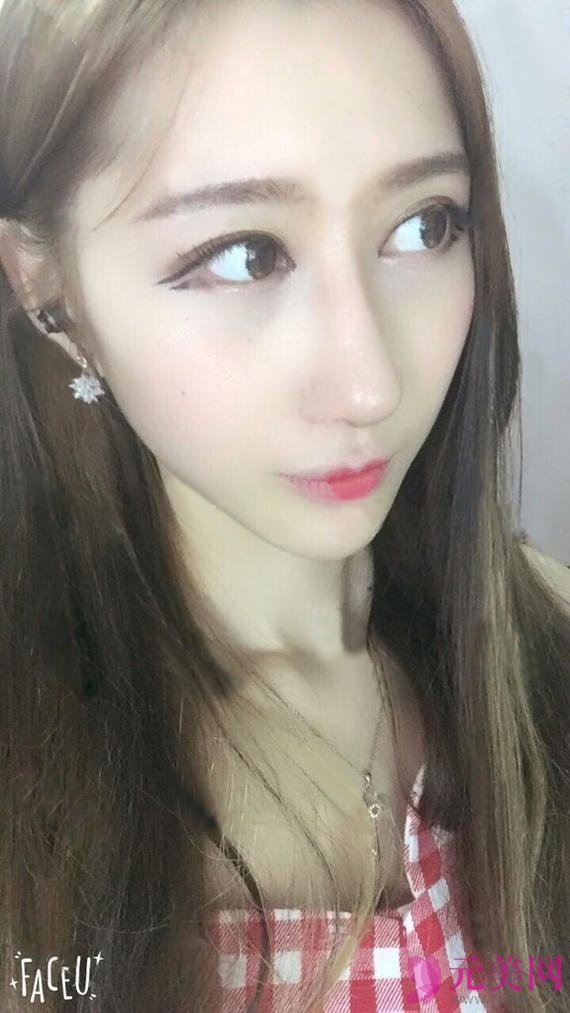假体隆鼻+耳软骨垫鼻尖