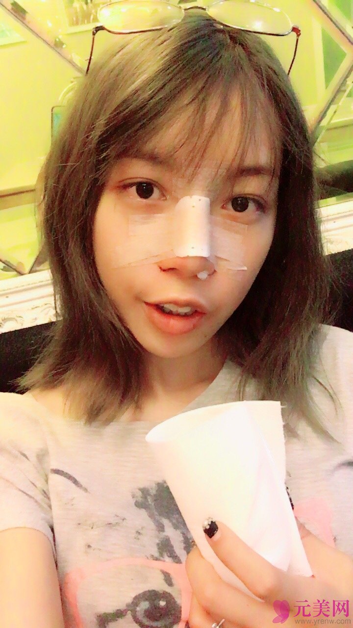 广州越秀丽尚李军膨体隆鼻真人案例