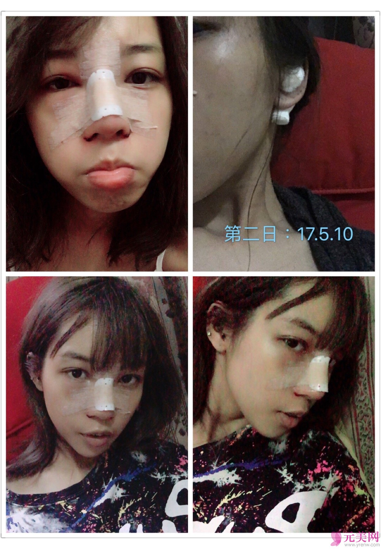 广州越秀丽尚李军膨体隆鼻真人案例