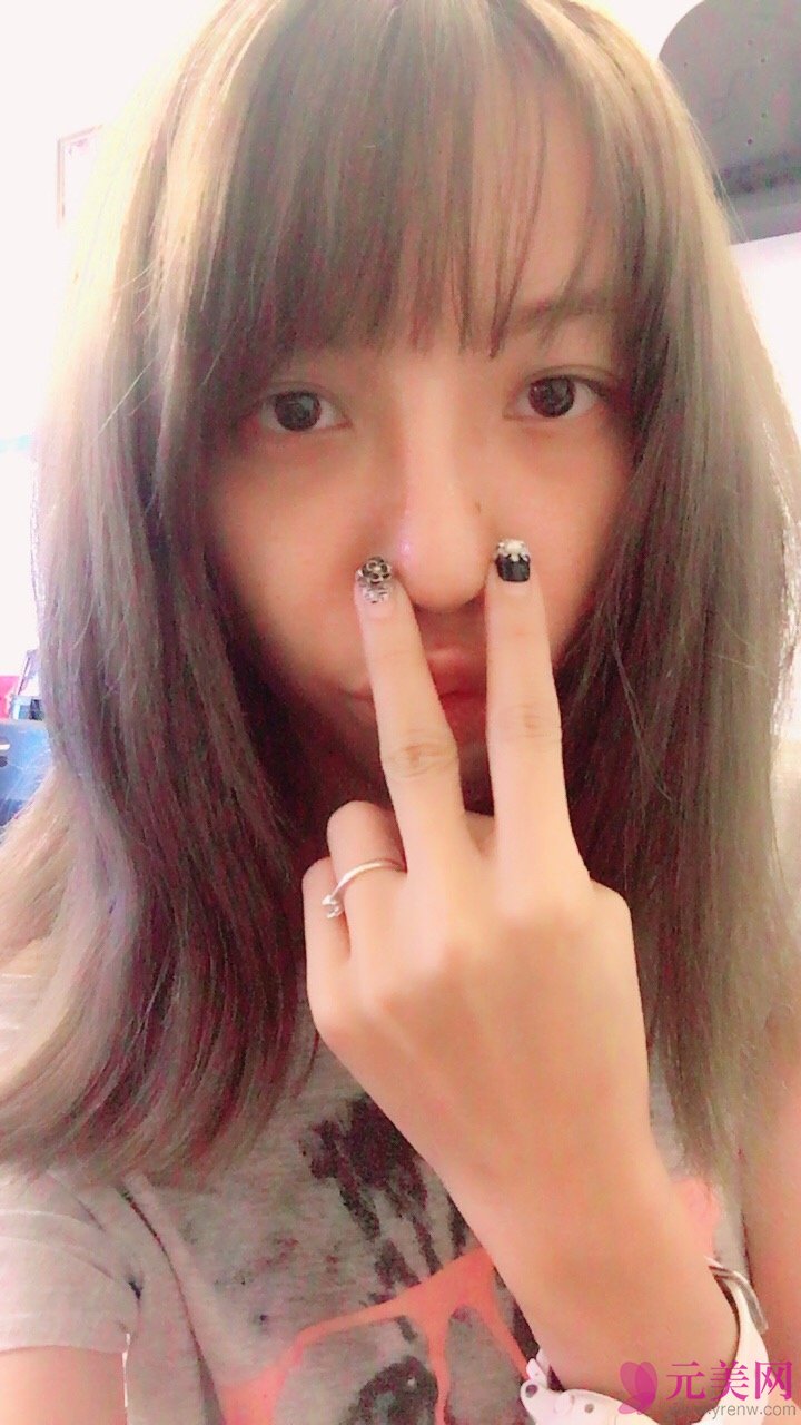 广州越秀丽尚李军膨体隆鼻真人案例