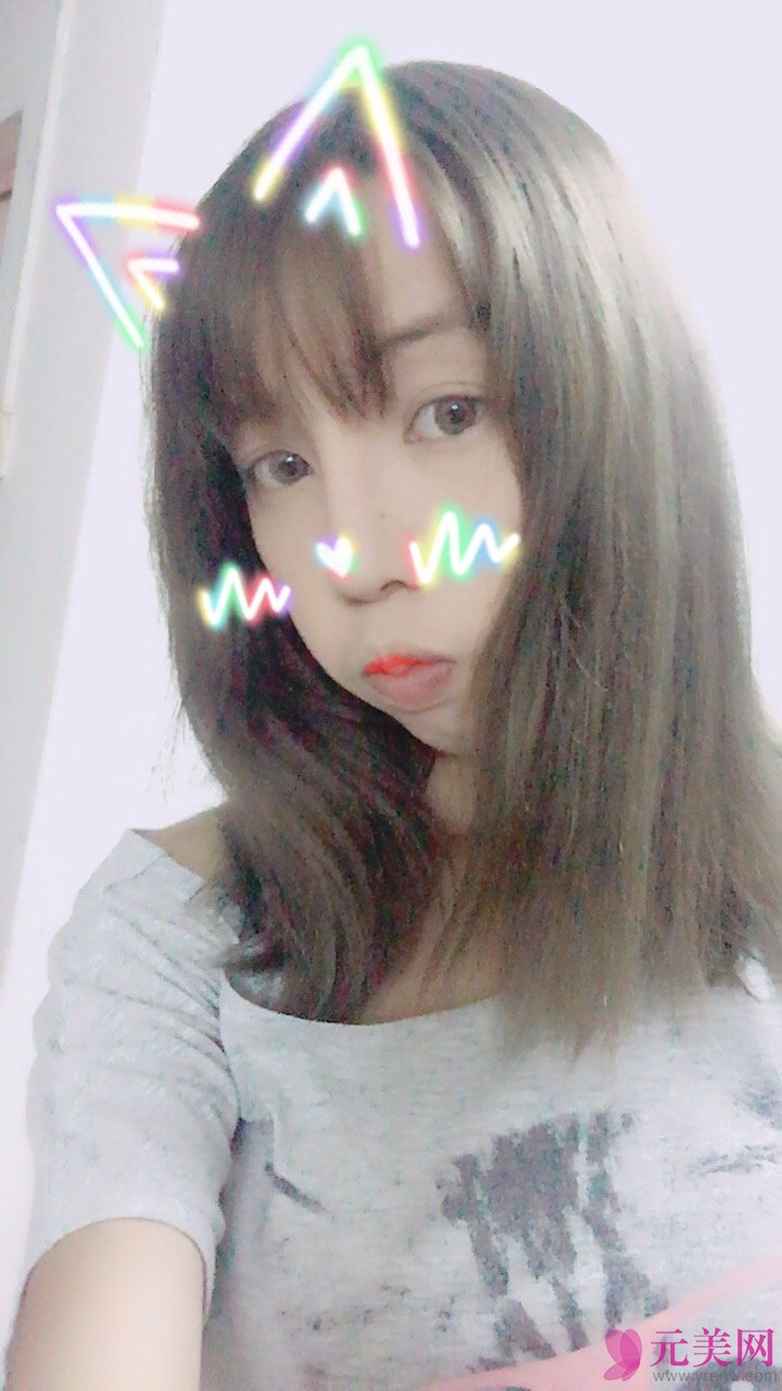 广州越秀丽尚李军膨体隆鼻真人案例
