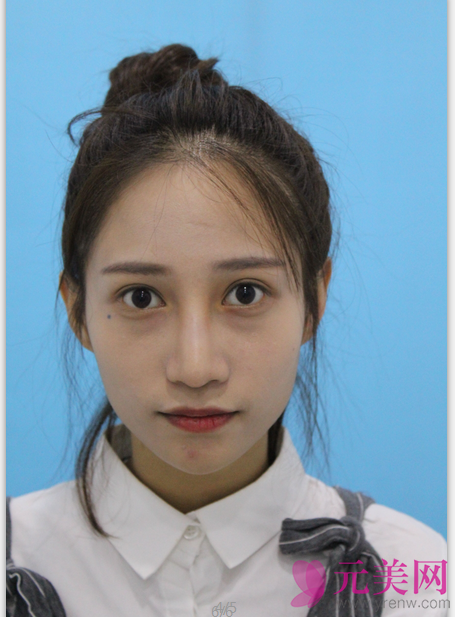 深圳铭医张青松鼻部手术+自体脂肪填充真人案例