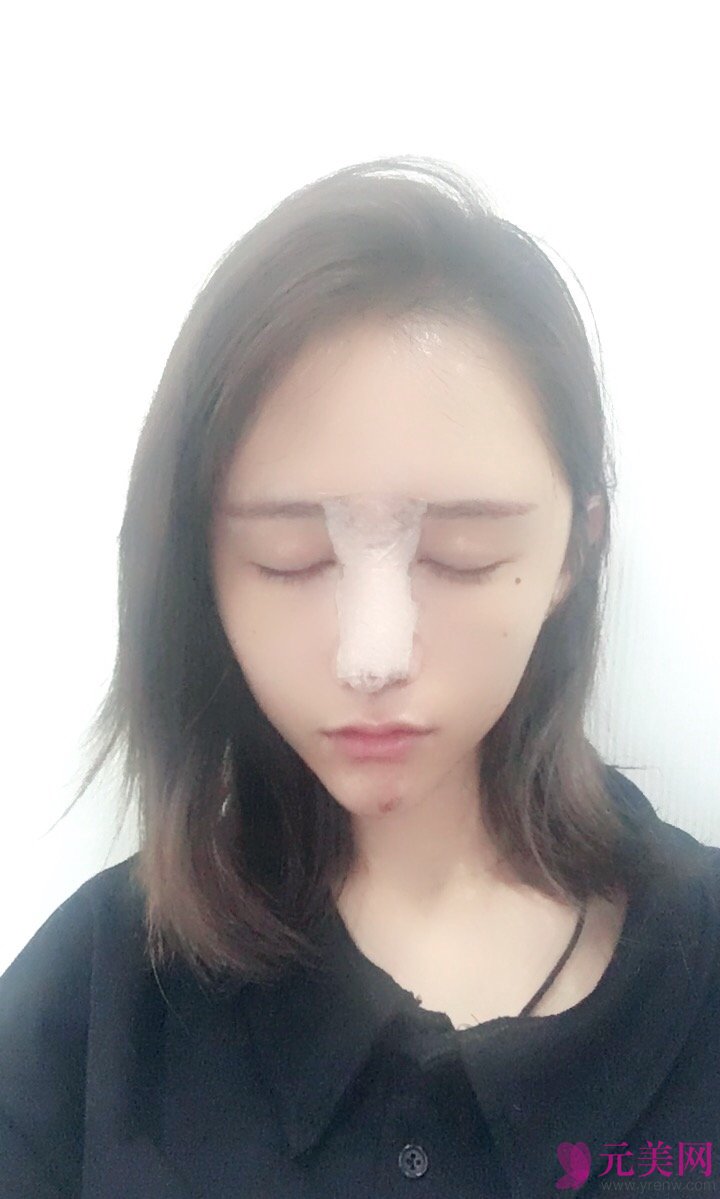深圳铭医张青松鼻部手术+自体脂肪填充真人案例