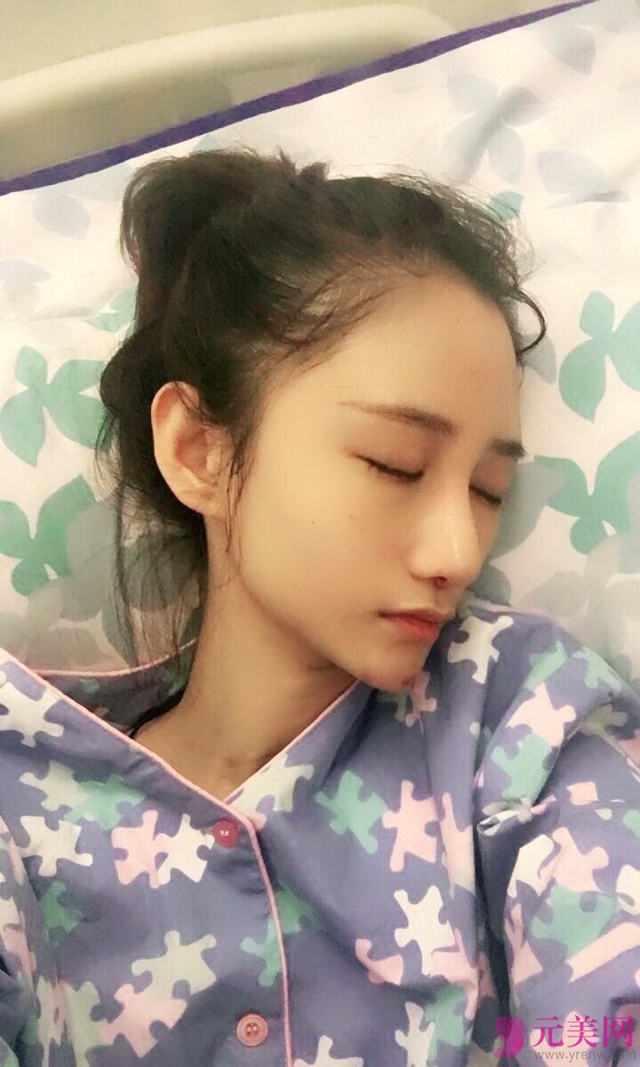 深圳铭医张青松鼻部手术+自体脂肪填充真人案例