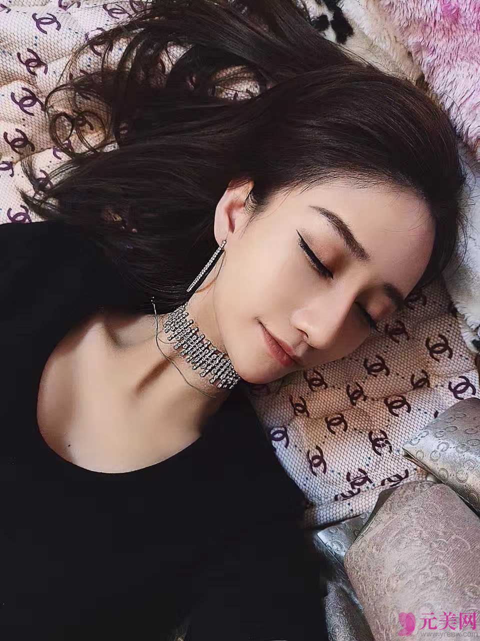 深圳铭医张青松鼻部手术+自体脂肪填充真人案例