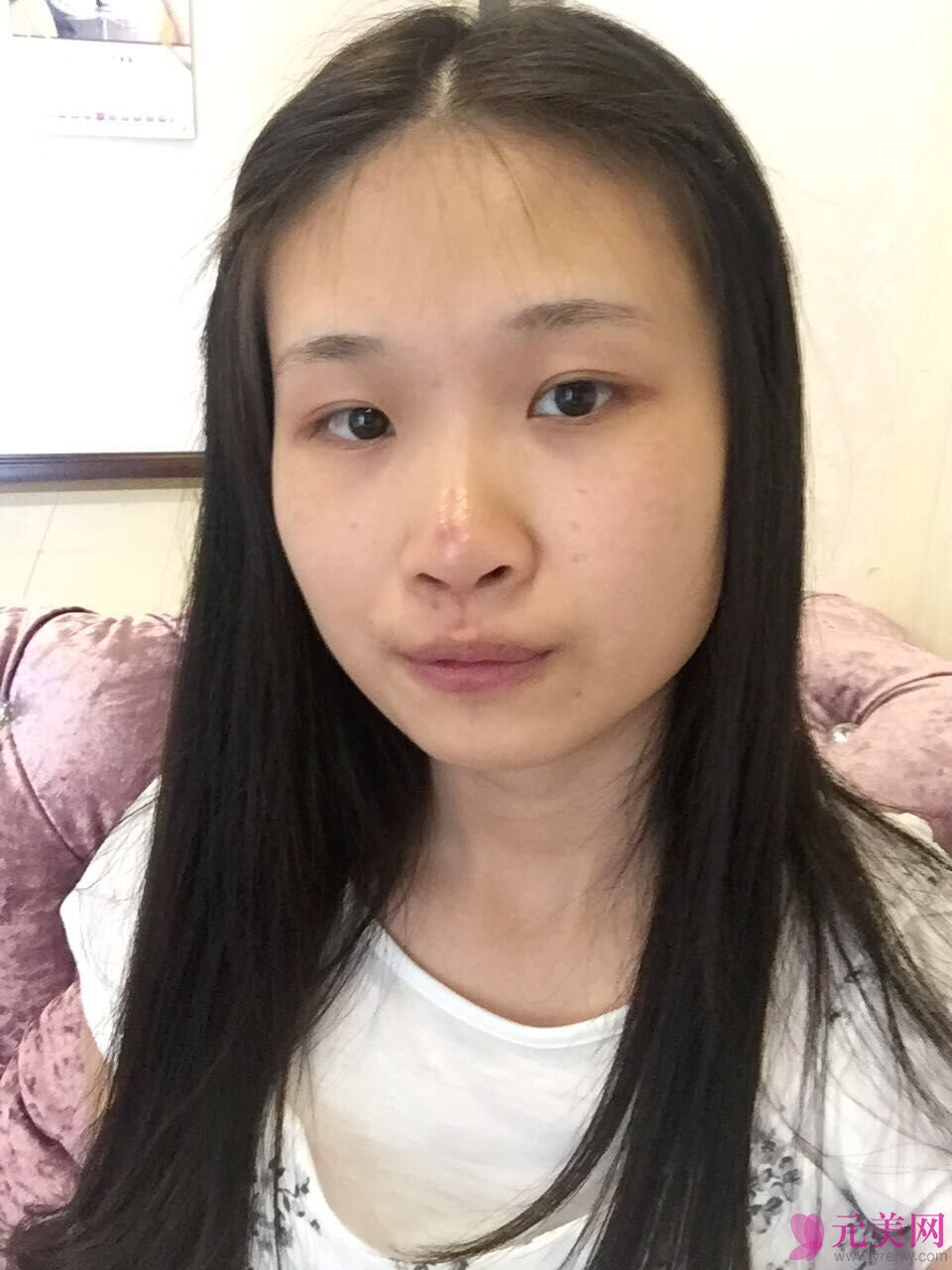 成都艾米丽潘红伟自体软骨前后对比真人隆鼻案例