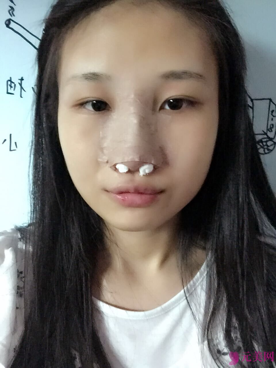 成都艾米丽潘红伟自体软骨前后对比真人隆鼻案例
