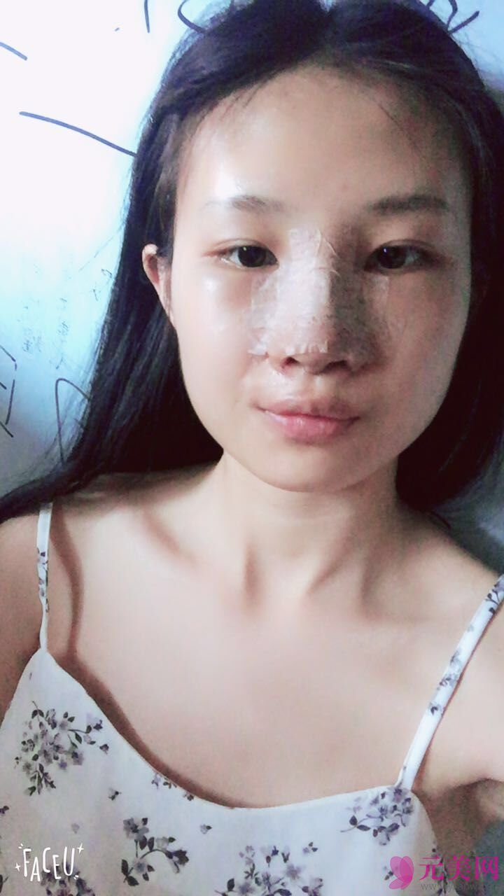 成都艾米丽潘红伟自体软骨前后对比真人隆鼻案例