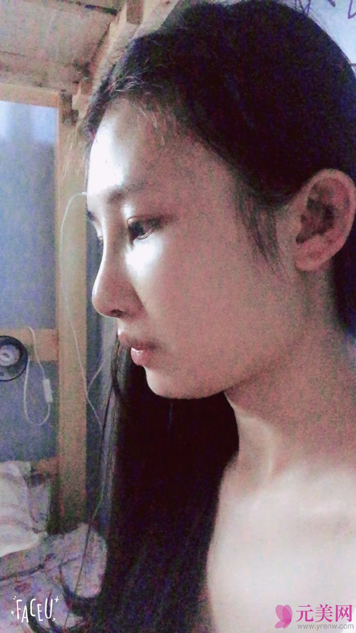 成都艾米丽潘红伟自体软骨前后对比真人隆鼻案例