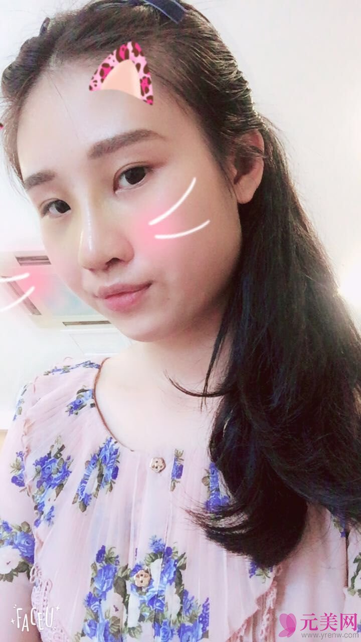 成都艾米丽潘红伟自体软骨前后对比真人隆鼻案例
