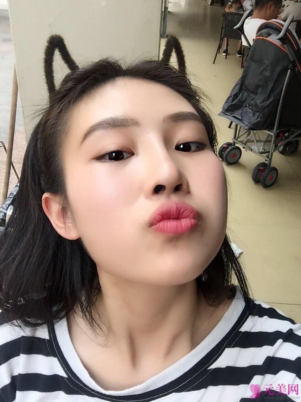 成都艾米丽潘红伟自体软骨前后对比真人隆鼻案例