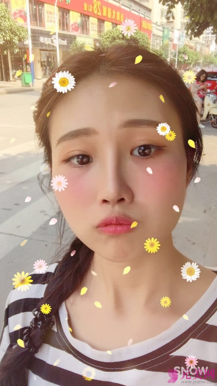成都艾米丽潘红伟自体软骨前后对比真人隆鼻案例