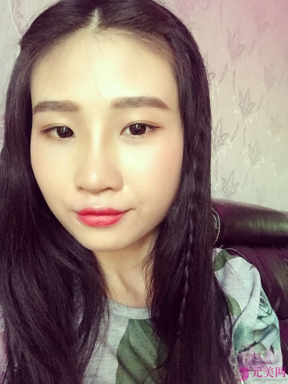 成都艾米丽潘红伟自体软骨前后对比真人隆鼻案例