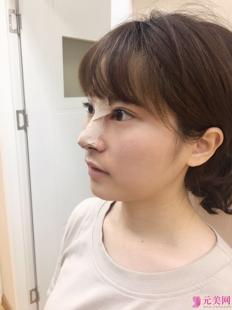 郑州星艺王慧君假体隆鼻和缩鼻翼真人隆鼻案例