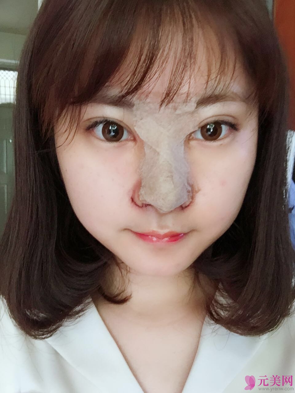 郑州星艺王慧君假体隆鼻和缩鼻翼真人隆鼻案例