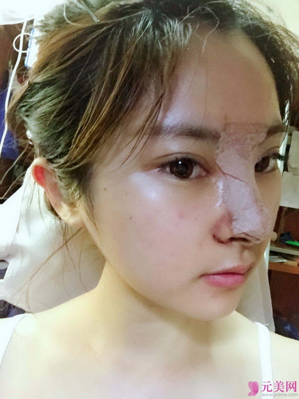 郑州星艺王慧君假体隆鼻和缩鼻翼真人隆鼻案例